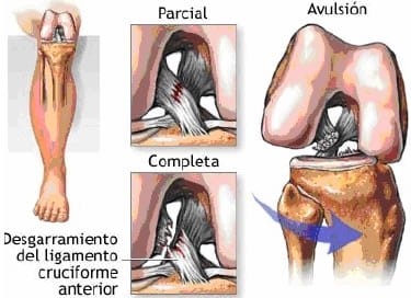 Rodillera dinámica para el ligamento cruzado posterior (LCP) con