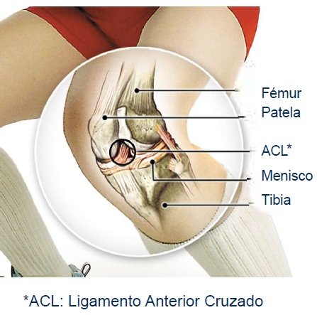 ligamento Anterior cruzado - Lesión de rodilla en mujeres